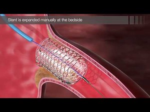 Chapter 20 - CorPath: Robot Assisted Coronary Intervention