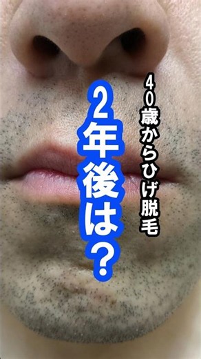 【家庭用脱毛器 ひげ脱毛24か月目🪒】40歳から始めて2年。ヒゲはここまで変わりました！ #メンズ脱毛 #家庭用脱毛器 #ヒゲ脱毛 #脱毛