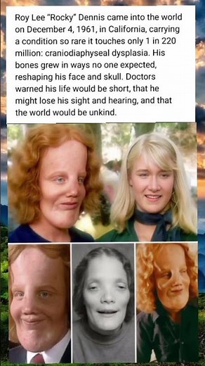 Extraordinary Life of Roy Lee 'Rocky' Dennis, Born with Rare Craniodiaphyseal Dysplasia