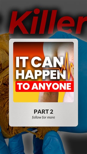 Institute of Human Anatomy on Instagram: "My Brother Had a Heart Attack During a Half Marathon: Part 2 - The Race 🏃💔 Running a Spartan Beast (half marathon + 30 obstacles) with my brother Jeff in California. He'd run a marathon 4 weeks earlier with zero issues. Race Day 🏁 Jeff was taking WAY too long. Cell service was terrible. Jeremy finally got one text through via satellite. Jeff's response: "I'm at the hospital. Not a joke. AFib." What Happened? 🚨 AFib causes 