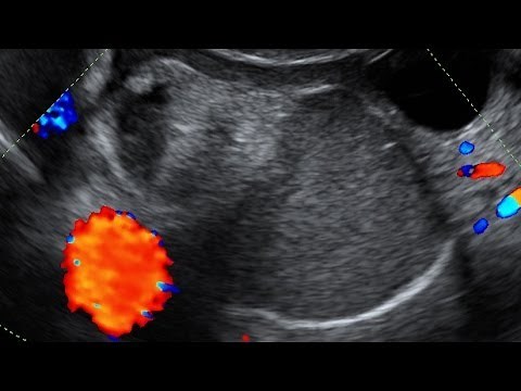 Ovarian Dermoid Cyst on Transvaginal Ultrasound