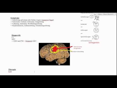 Schlaganfall (Apoplex): Definition, Symptome, Diagnostik & Therapie
