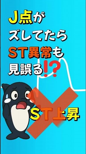 病棟でとった心電図、ST上昇のJ点ってなに？part47#心電図 #心電図検定 #雑学 #看護師 #訪問看護師 #おすすめ #医学生 #シャチ #鬼滅の刃