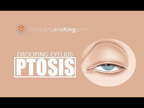 Drooping Eyelids | What causes Ptosis and How is it Treated