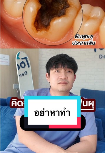 การรักษาฟันผุทะลุประสาท: ทำยังไงดี?