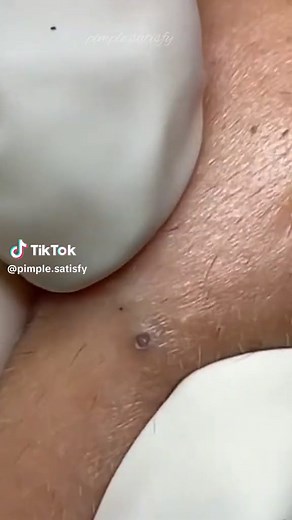 Super satisfied 🤗 #relaxing #foryou #pimple #tiktoklongs #fyp #explor #pimplepop #satisfyingvideo #foryoupage