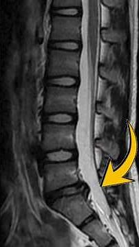 ⚡ Disc Bulge on MRI… But NO Pain? 😱 Here’s WHY!