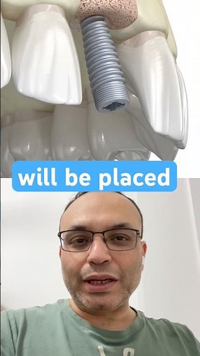 Broken Front Tooth? 😳 Fixed with Implant! #dentist #implanttreatment #dentalimplants
