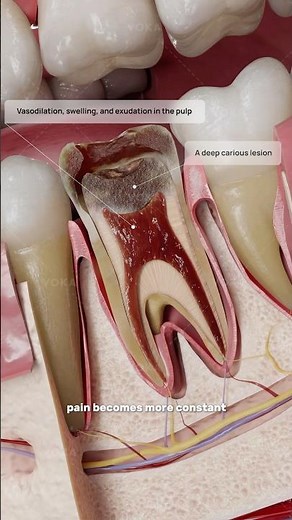 What is acute pulpitis and how does it affect tooth health? 🦷 3D animation