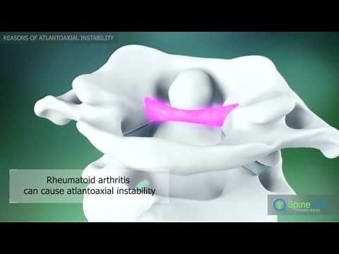 Atlantoaxial instability. Reasons