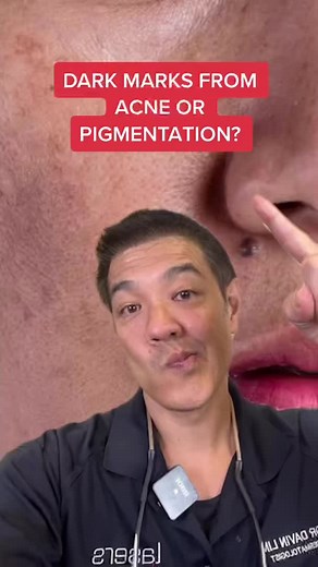 Effective Solutions for Dark Marks from Acne and Pigmentation