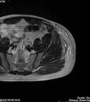 Tensor fasciae latae muscles rupture