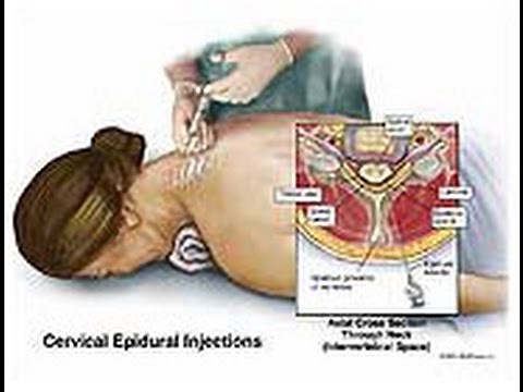 The step wise guide to Cervical Epidural Steroid Injection