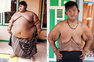 World’s fattest kid left with horrendous excess skin after losing 16 stone…but insists he’s happier