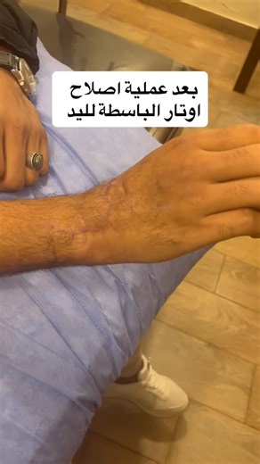 Rewan Zaky & Zaky Saleh on Instagram‎: "After 6 physiotherapy sessions following extensor tendon repair surgery, we’re seeing a clear improvement in range of motion and a gradual return of strength and functional use. بعد 6 جلسات علاج طبيعي عقب جراحة إصلاح أوتار البسط، بدأ يظهر تحسّن واضح في مدى الحركة مع استعادة القوة بشكل تدريجي والرجوع للاستخدام الوظيفي لليد. #عظام #علاج_طبيعي #علاج_طبيعي_وتأهيل #physio"‎