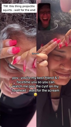 Epic FaceTime Reaction to Popping a Forehead Cyst