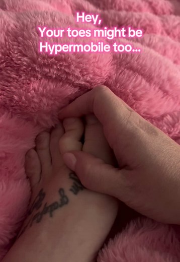 Understanding Hypermobile Toes: Signs and Symptoms