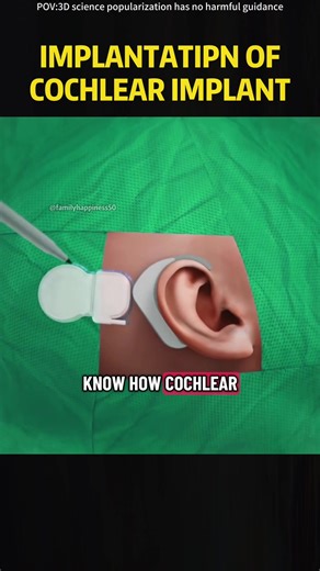 Cochlear Implant Surgery Procedure Medical animation 3D #cochlearimplant #cochlearimplants #earsurgery #hearing #hearingloss #treatment #medicalanimation