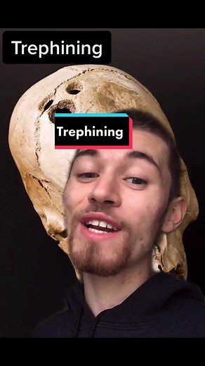 Medicine through time: Trephining 💀 #fy #trephining #trepanning #medicinethroughtime #surgery #ancient #health #headacherelief #educational