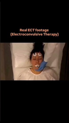 ECT procedure reserved for severe Psychiatric patients treatment #medicaleducation