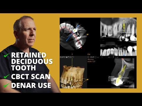 Implant Planning using CBCT - Dentistry Case by Dominic Hassall