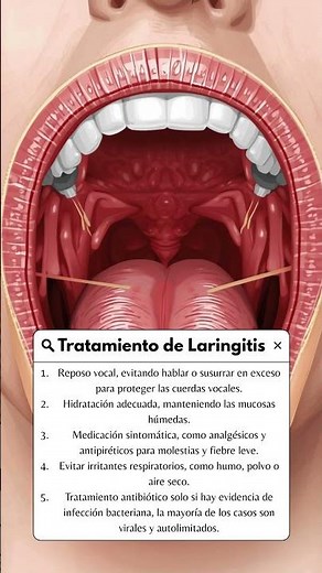 ¿Como tratar la laringitis? #laringitis #dolordegarganta #medicina #salud