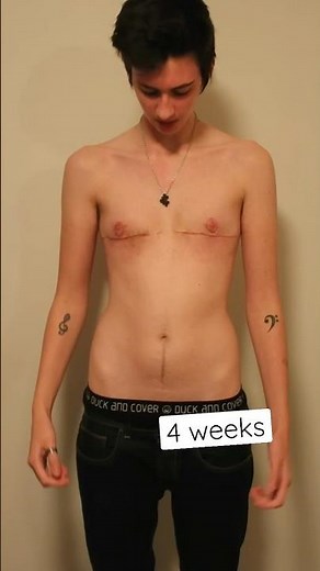 Trans Guy top surgery comparison