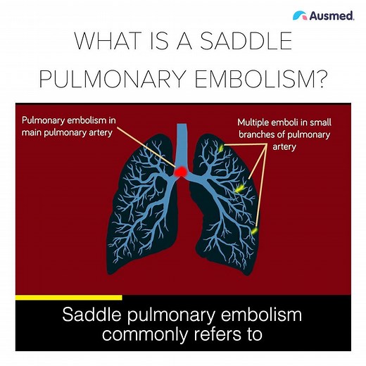9.1K views · 55 reactions | WHAT IS A SADDLE PULMONARY EMBOLISM (PE)? Know the signs and recognise a saddle PE early. ♥️ For more interactive learning on embolisms and blood clotting, view the online Course "Venous Thromboembolism" online NOW at https://www.ausmed.com/cpd/courses/venous-thromboembolism | Ausmed | Facebook