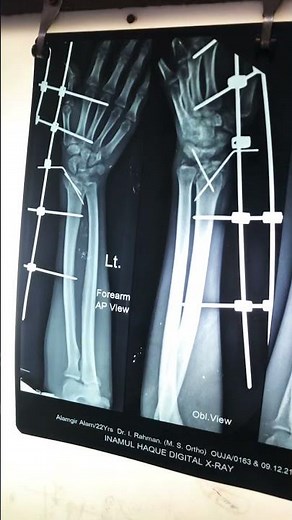 Comminuted colles fracture can be treated by External fixator also… hand remains mobilized thru out.
