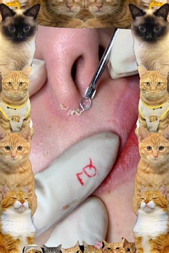 Cyst Popping and Blackhead Removal: Satisfying Skincare