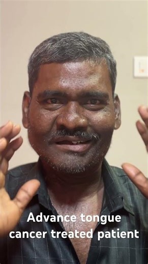 Advanced Tongue Cancer Recovery Story | Speech After Glossectomy | Radial Forearm #drmanishtiwari