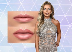 We Ask An Expert Of The Risks Involved With Excessive Lip Filler