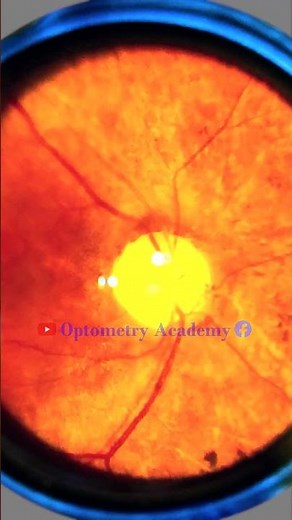 Retinitis pigmentosa | bone spicules | narrowed retinal vessels | Fundus | Short Video 211 #viral