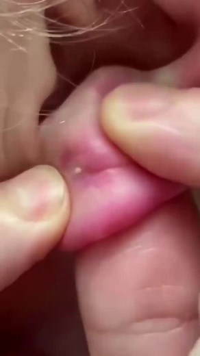 pimples on faces #cravos #blackhead #zit #popper #acne #zits #pimplepop #pimple #popping #asmr #pimples #fyp #live