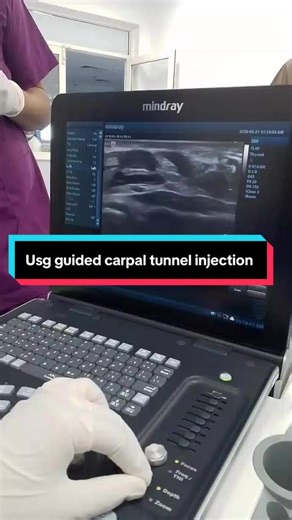 USG Guided Carpal Tunnel Injection for Pain Relief