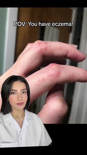 1.6M views · 3.5K reactions | Dyshidrotic eczema is a skin condition that causes small blisters on the palms of hands, soles of the feet and edges of the fingers and toes. If you have it, Keep your hands moisturized! #eczema #dyshidroticeczema #dryhands | Dr. Farzan | Facebook