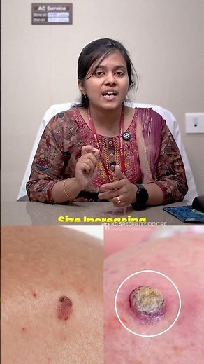 Skin Cancer Awareness Month Early Signs & Prevention Tips by Dr Sowmya S Aithal