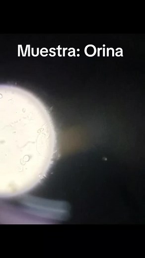 La tricomoniasis es una infección de transmisión sexual de la vagina o de la uretra causada por el protozoo Trichomonas vaginalis, que cursa con secreción e irritación vaginales y, en ocasiones, con síntomas urinarios. Las mujeres presentan un flujo vaginal amarillo verdoso, espumoso y con olor a pescado, además de irritación y dolor en el área genital. Los hombres no suelen tener síntomas, pero puede haber una secreción espumosa, y dolor leve o malestar durante la micción. #muestra #orina #uroa