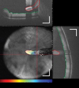 Intraoperative optical coherence tomography for ophthalmic surgical guidance
