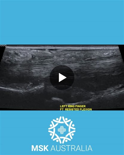 Finger pulley injuries are not always obvious on static imaging—but dynamic assessment is critical. This case demonstrates a clearly abnormal A2–A4 pulley injury, with significant flexor tendon… | MSK Australia