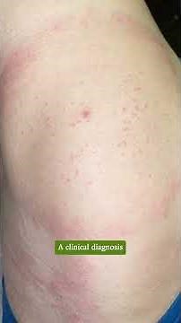 Images in Clinical Medicine: Southern Tick-Associated Rash Illness