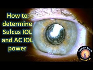 sulcus IOL placement in complicated cataract surgery