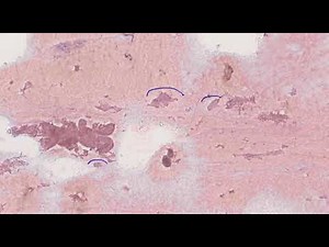 Thyroid cytology: Colloid nodule