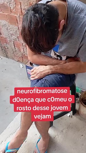 Simulações de cura para o homem sem rosto - Parte 3 | Neurofibromatose