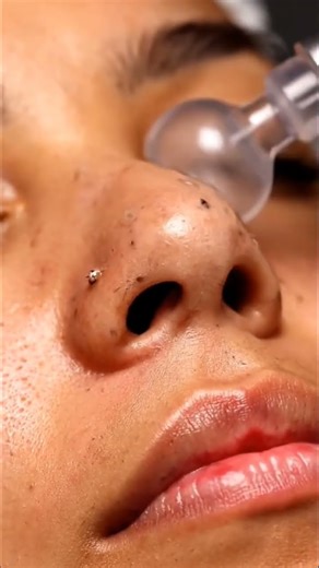 Soothing Nose Cleaning ASMR ✨ Gentle Suction, Soft Pops & Pure Relaxation