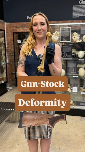 Why is this bone bent like that? What looks like a simple crooked elbow is actually something far more specific—gun-stock deformity, also known as cubitus varus. This distinctive inward bend of the arm resembles the angle of an old rifle stock, and it’s most often the long-term result of a childhood fracture that healed improperly. In this video, we take a close look at how this deformity shows up on real bone, what causes it, and how it affects movement and function. From supracondylar fracture