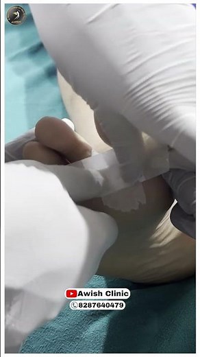 Plantar Wart Removal: A Step-by-Step Guide |People Thinks its Corn Wart |is that true?|AWISH Clinic