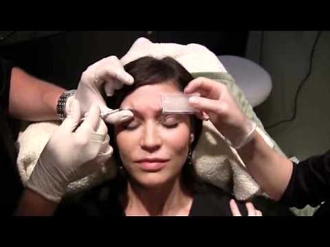 Botox Brow Lift
