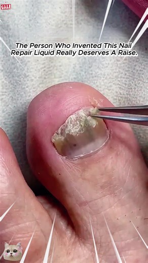 Pin the top video in the lower left corner of the home page, and you can also send me a private message to get it.#nailfungus #nailrepair #fungalnails #antifungal #Summervibes