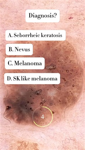 What is this ? A. Seborrheic keratosis B. Nevus C. Melanoma D. SB like melanoma (Prepared with Dr Joanna Goldberg MD) | Dermatology News Daily